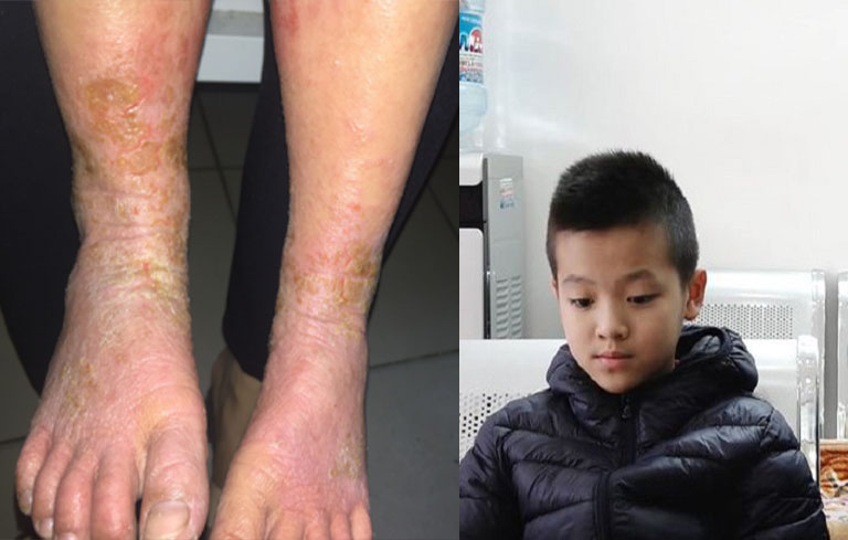 Biểu hiện viêm da cơ địa mà bé Trung gặp phải trước khi điều trị tại Trung tâm Thuốc dân tộc