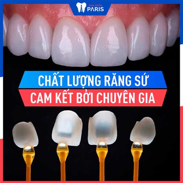 Dán sức veener cao cấp 