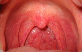 Đau rát vòm họng trên có thể là biểu hiện đặc trưng của các vấn đề về đường hô hấp