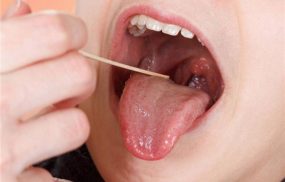 Viêm hầu họng có tăng sinh mô hạt là tên gọi khác của bệnh viêm họng hạt ở giai đoạn mãn tính