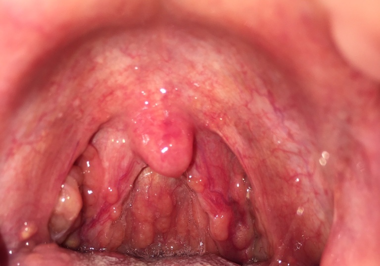 Bệnh viêm họng hạt ở trẻ em là gì?