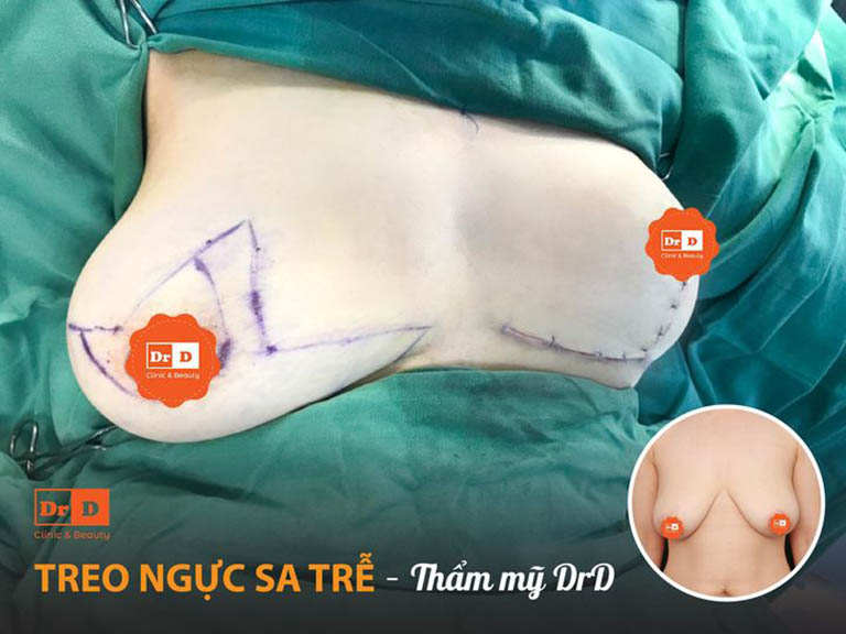 địa chỉ phẫu thuật treo ngực sa trễ tại Hà Nội
