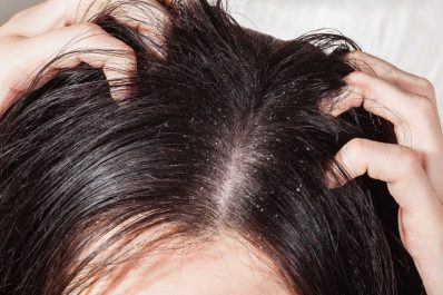 Bệnh nấm da đầu có lây không?