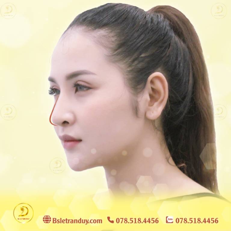 Nâng mũi bọc sụn tạo dáng mũi Hàn Quốc