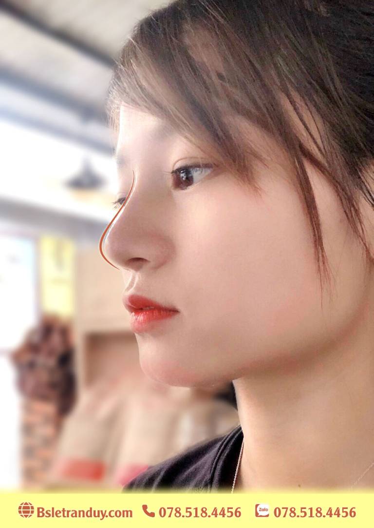 Nâng mũi S-line