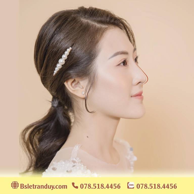 Nâng mũi Hàn Quốc là gì?