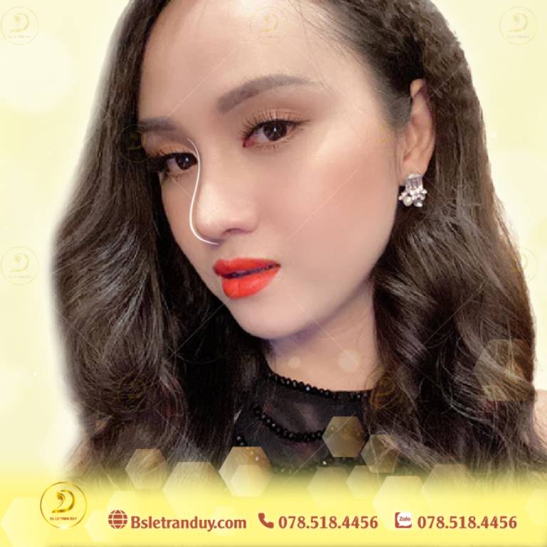 ưu điểm nổi bật của phương pháp nâng mũi Hàn Quốc