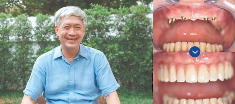 Hình ảnh bác Đan trước và sau khi trồng Implant tại Vidental