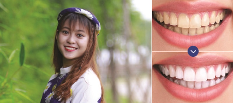 Hình ảnh hàm răng trước và sau khi tẩy trẳng của Ngọc Quyên