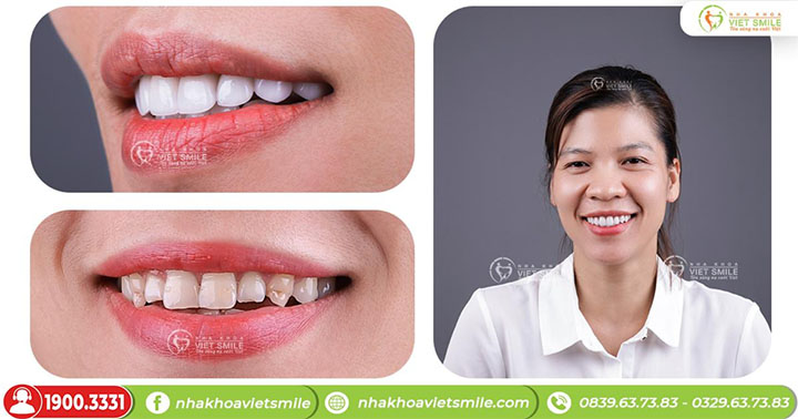 Nha khoa Việt Smile 6 dán răng sứ 