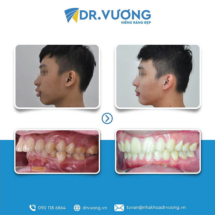 Trước và sau khi niềng răng tại Dr Vương 