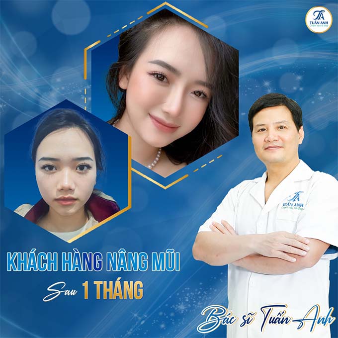 Nâng mũi đẹp tại Hà Nội, bác sĩ thẩm mỹ Tuấn Anh 