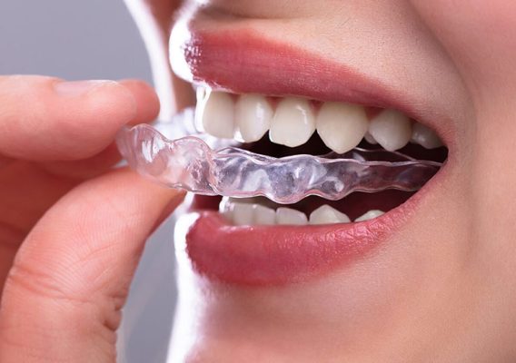 địa chỉ niềng răng trong suốt tại TPHCM