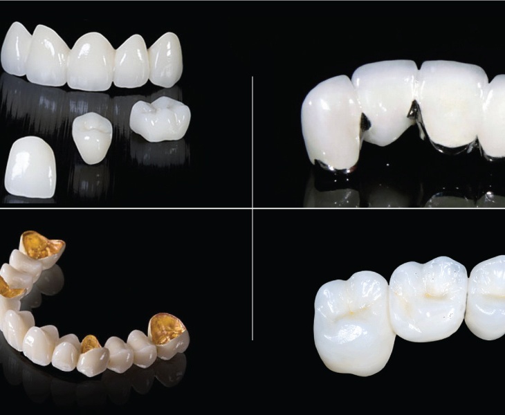 ViDental Clinic - địa chỉ bọc răng sứ cung cấp vật liệu sứ cao cấp 
