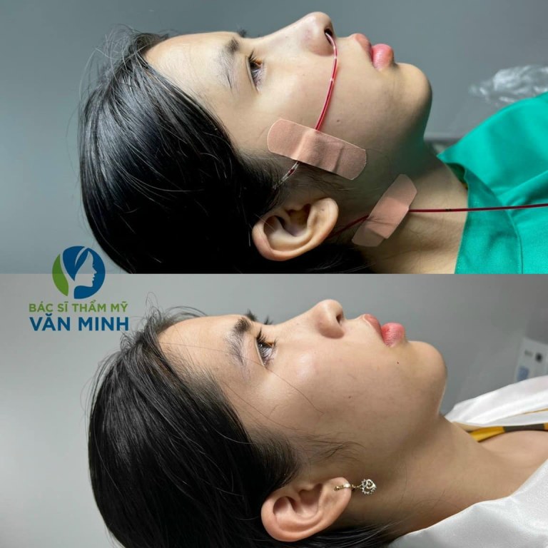 dịch vụ thẩm mỹ mũi ở TMV Dr. Trịnh Văn Minh