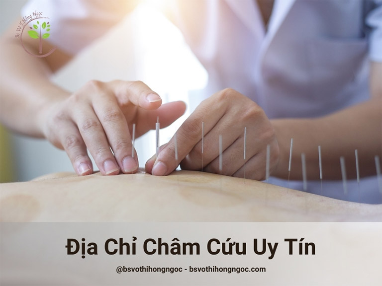 châm cứu